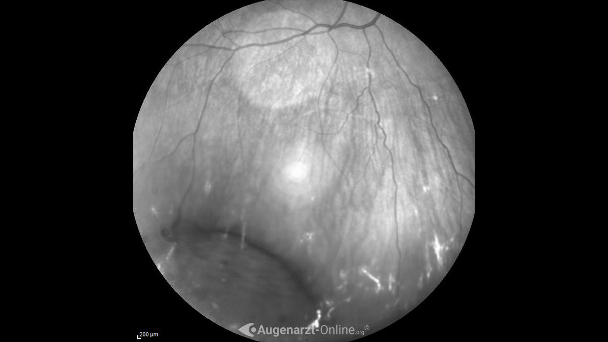 Retinoschisis Atlas der Augenheilkunde