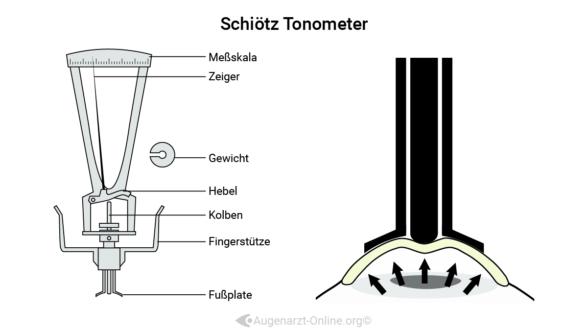 Indentationstonometrie nach Schiötz zur Bestimmung des Augeninnendrucks
