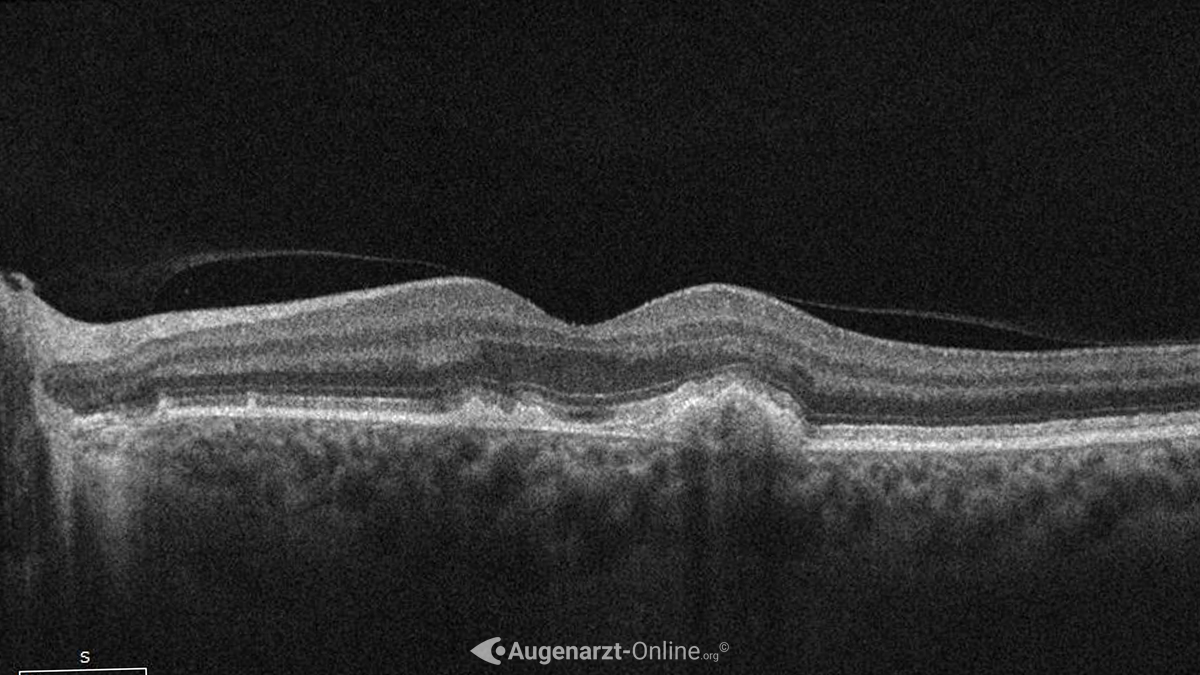 Optische Kohärenztomografie (OCT) einer multifokale Chorioiditis und Panuveitis