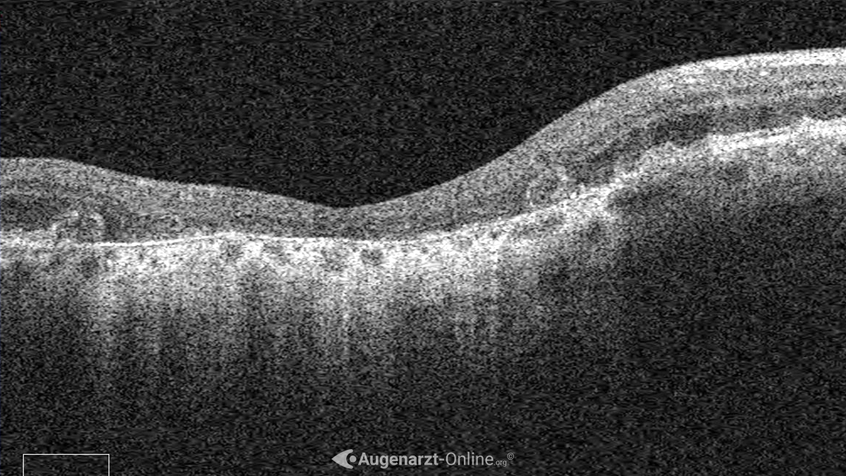 Fortgeschrittene Atrophie der Netzhaut in der optischen Kohärenztomographie
