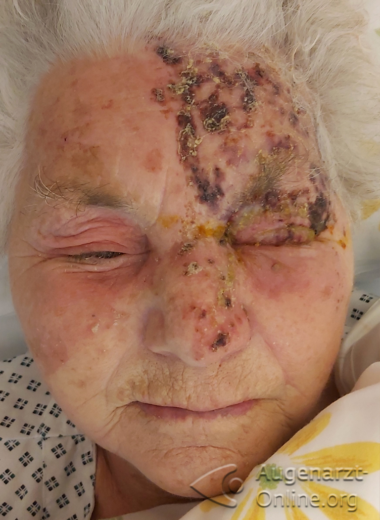 Herpes zoster ophthalmicus Ausschlag