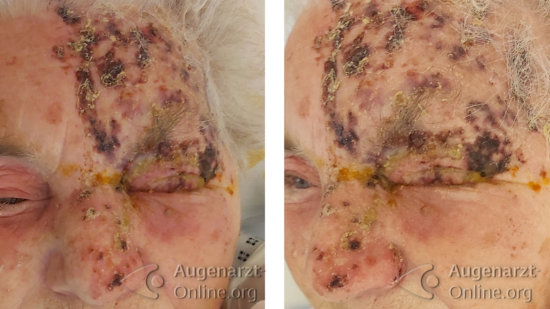 Herpes zoster ophthalmicus