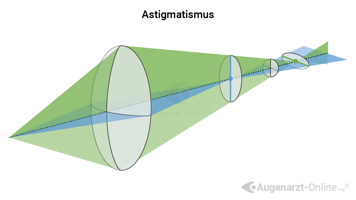Astigmatismus, Hornhautverkrümmung, Stabsichtigkeit, Hornhaut Verkrümmung, Physikalische Grundlagen, Torische Linse, Augen, Brille