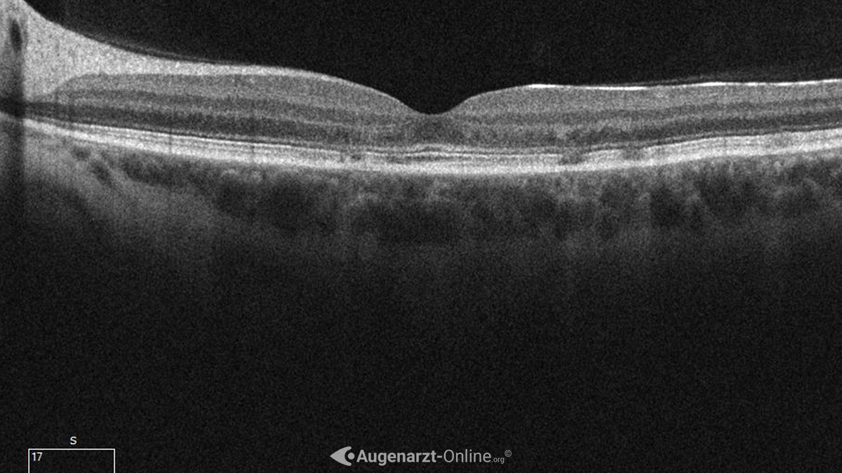 Tamoxifeninduzierte Retinopathie