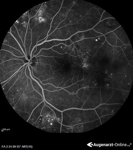 Proliferative Diabetische Retinopathie