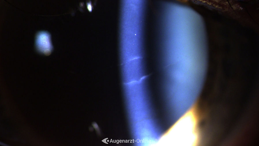 Spaltlampenfoto eines Descement Risses