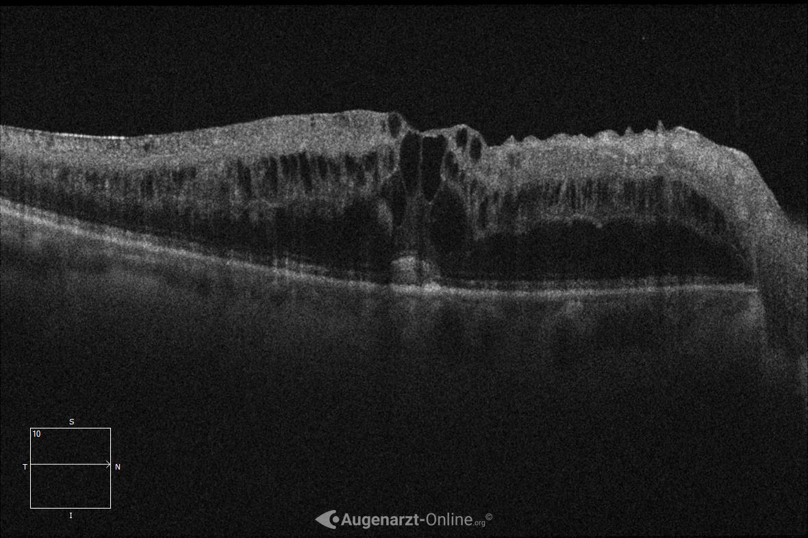 Zystoides Makulaödem bei Zentralvenenverschluss in der optischen Kohärenztomographie (OCT)