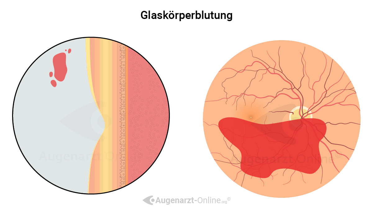 Glaskörperblutung grafische Erklärung und Veranschaulichung