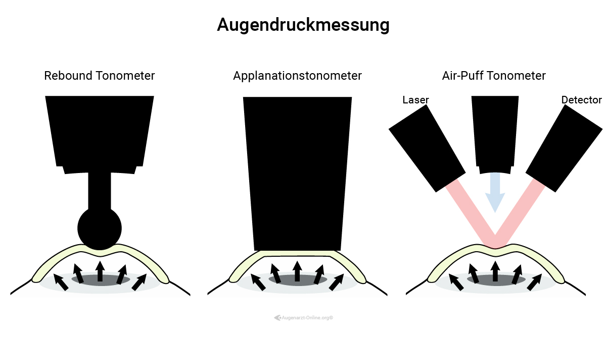 Verschiedene Methoden zur Bestimmung des Augeninnendrucks