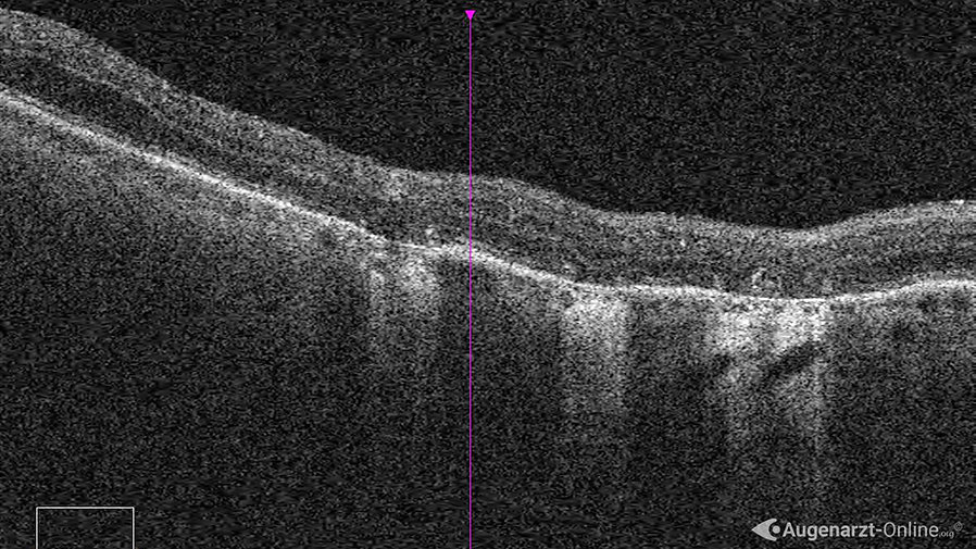 ALK Narben nach Netzhautlaser
