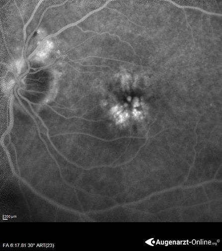 Leckagen in der Angiographie bei exsudativer AMD (Spätphase).