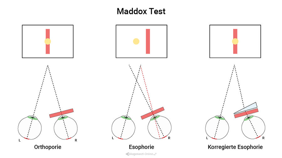 Maddox Test Strahlengänge  und Funktionsprinzip