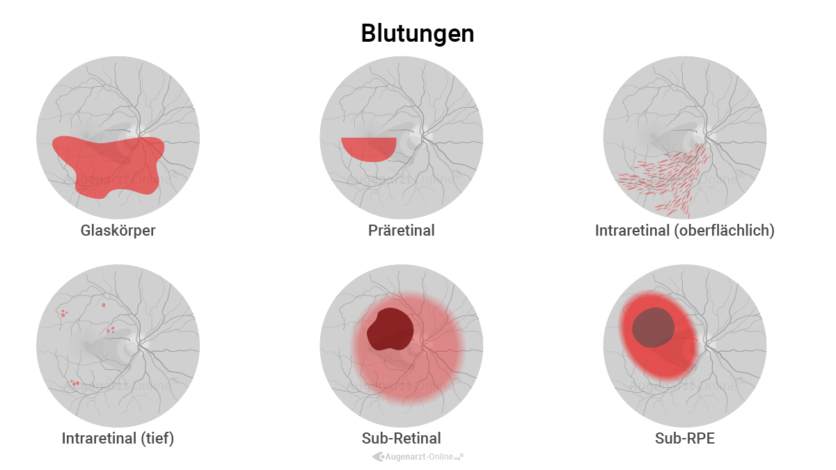 Veranschaulichung und Erklärung unterschiedlicher Arten von retinalen Blutungen