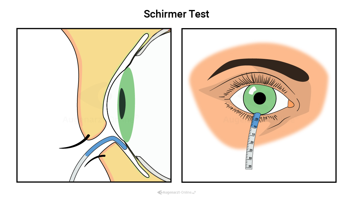 Schirmertest Durchführung Erklärung