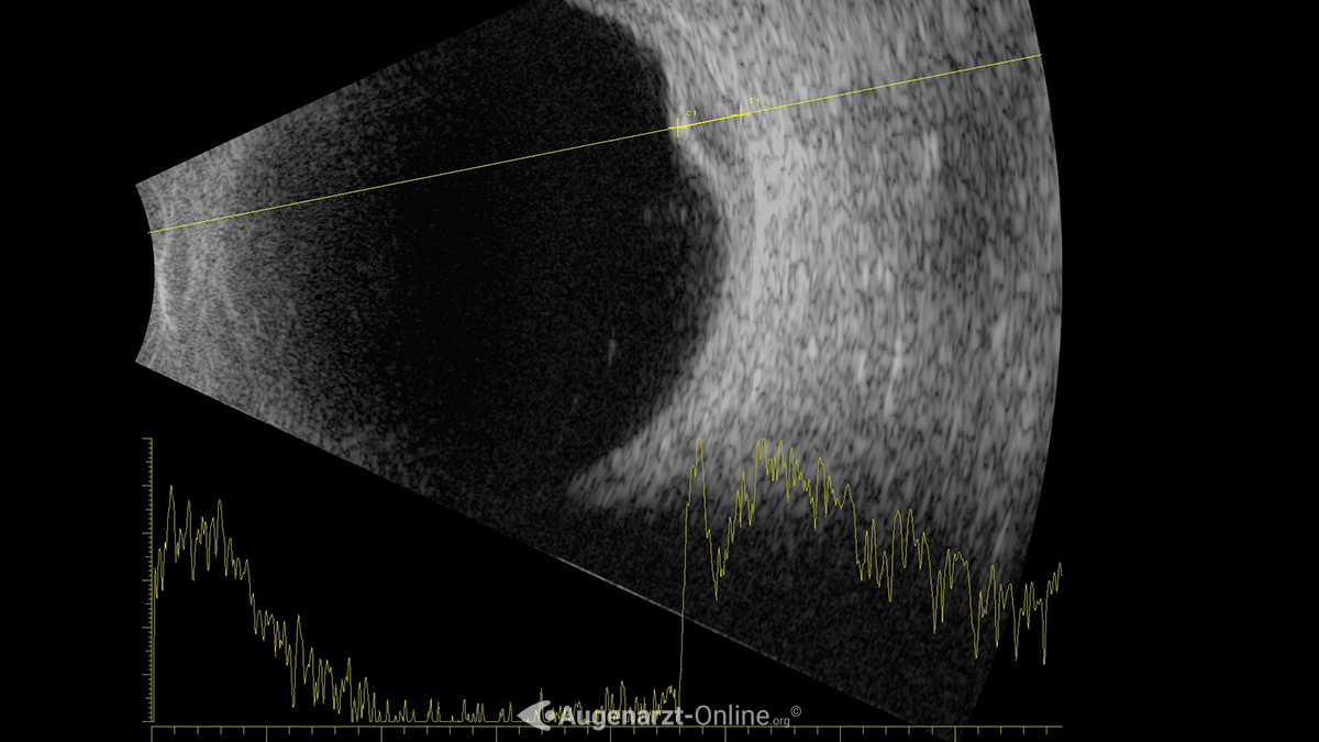 Ultraschall