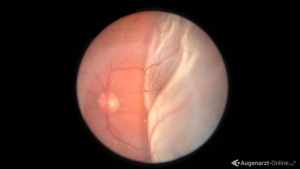 Fundusfoto einer Amotio retinae mit abgehobener Makula