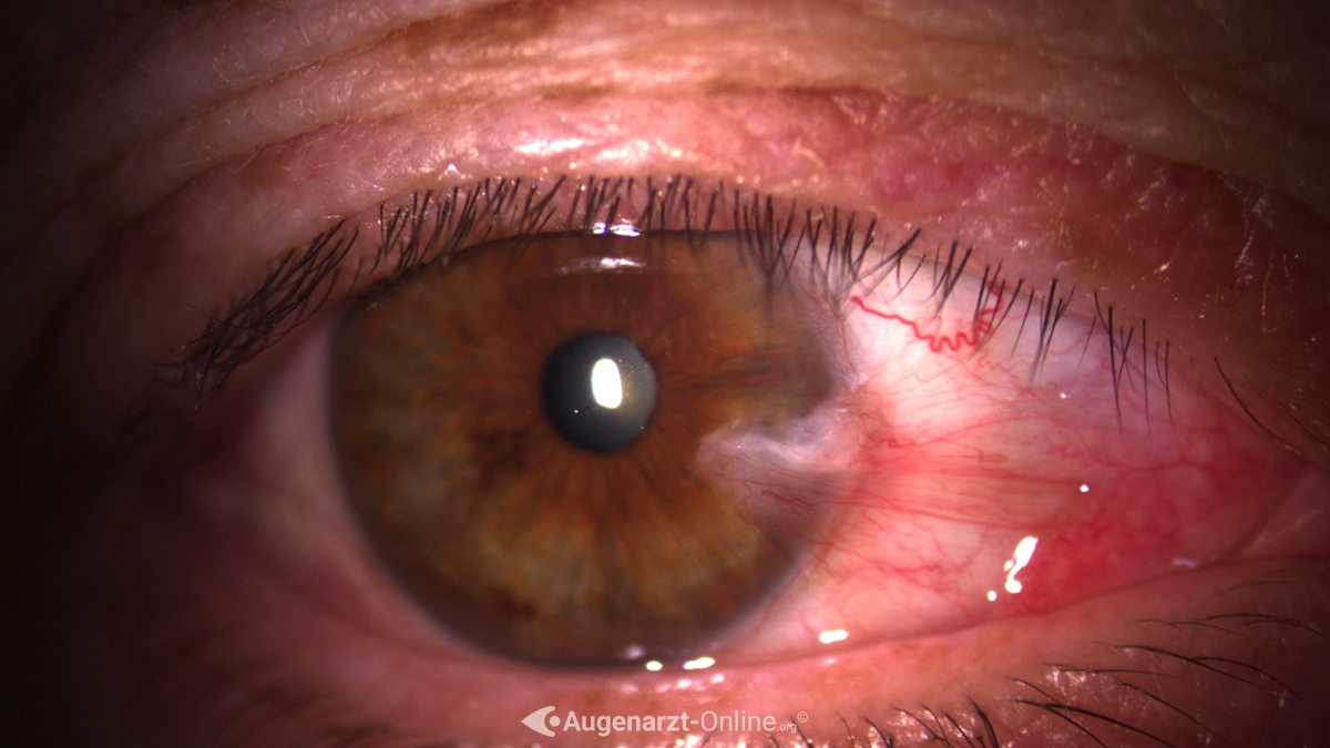 Pterygium Bild