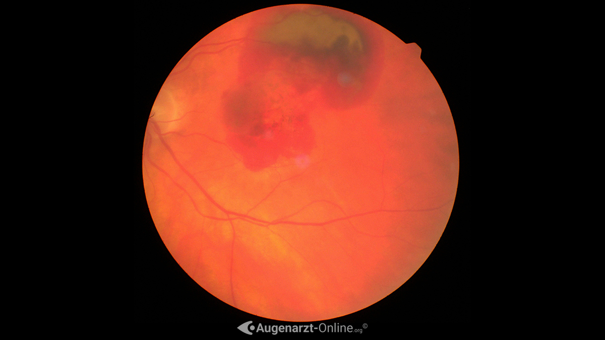 Exsudative AMD