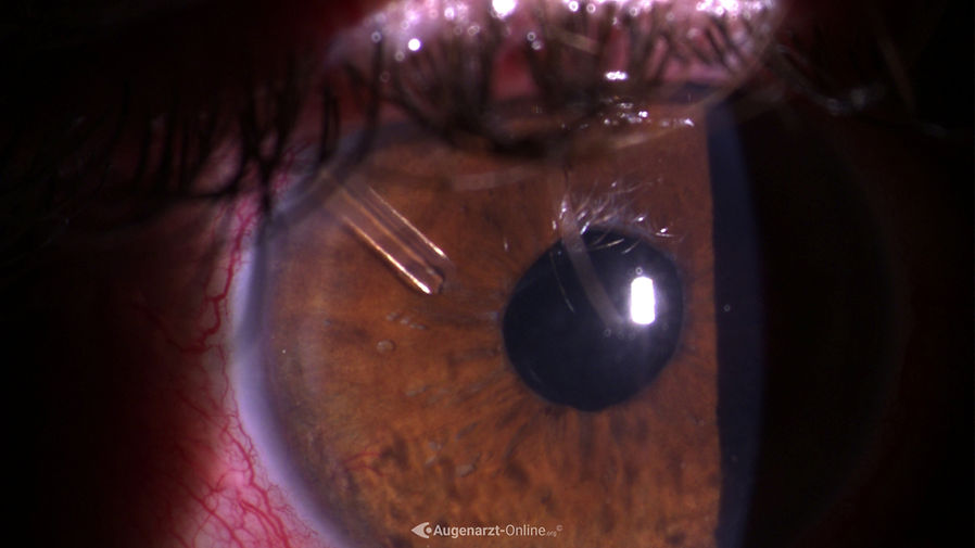 Lage des Ausgangspunktes eines Ahmed Valve Implantats ohne Iris oder Endothelkontakt.