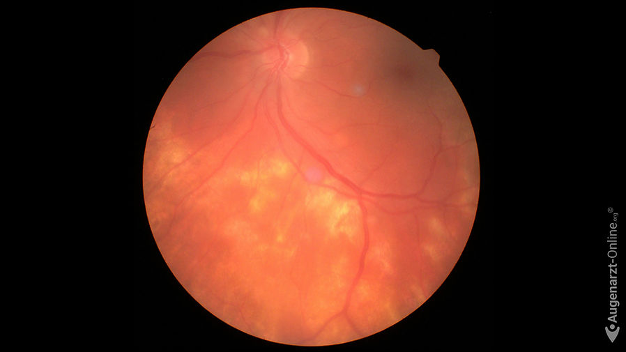 Serpiginöse Chorioretinitis mit subretinale Infiltrate, chorioretinale Narben.
