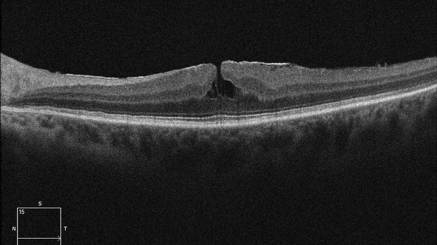 Epiretinale Gliose mit Pseudomembran im OCT.