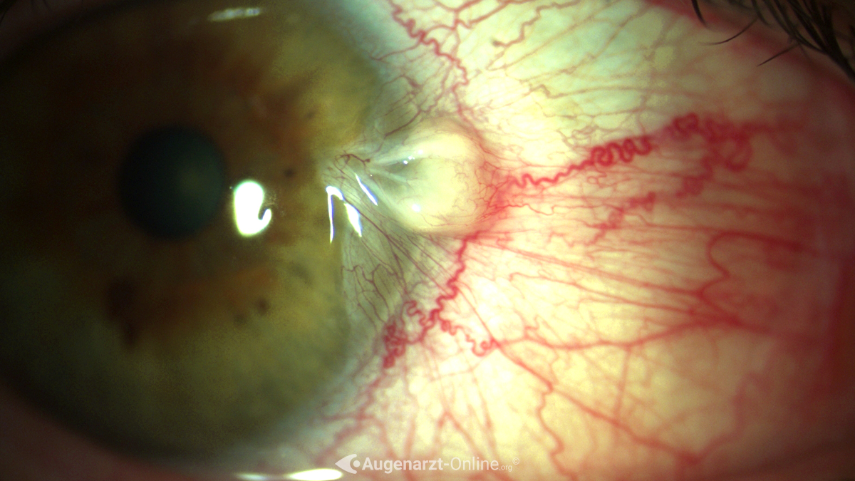 Foto Pterygium
