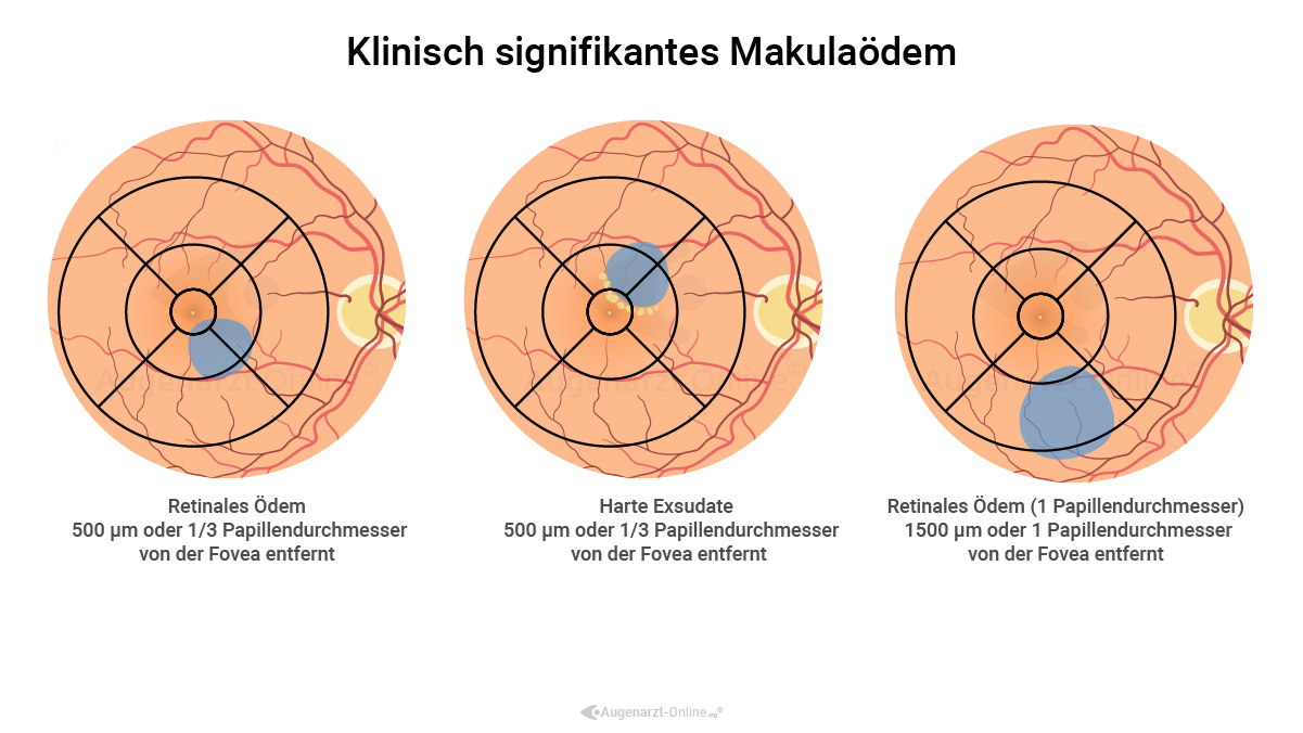 Intraretinale Flüssigkeit - Definition