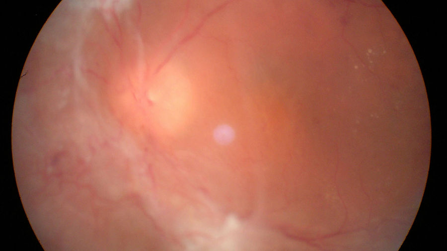 Ausgeprägtes Proliferationssegel bei fortgeschrittener proliferativer Diabetischer Retinopathie.