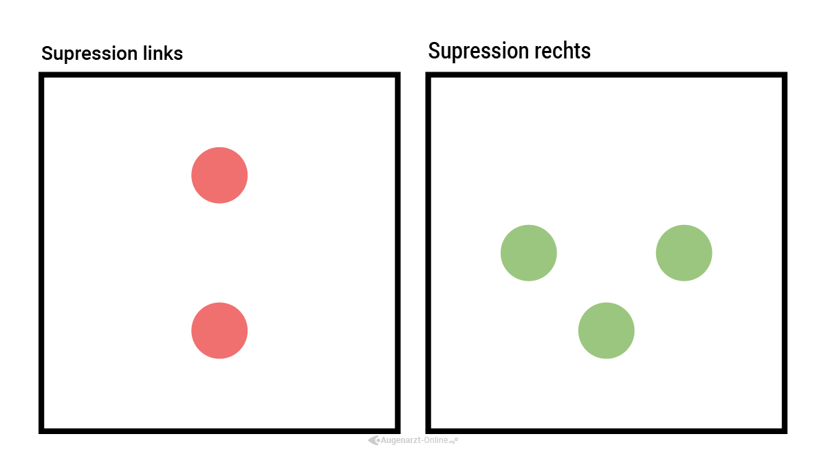 Suppression im Worth Four Dot Test