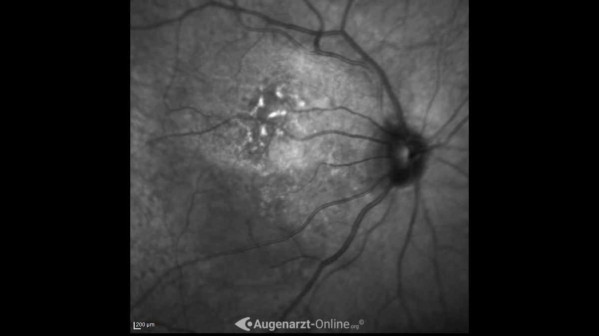 Aderhautmelanom Aderhautmelanom im Infrarotlicht der optischen Kohärenztomografie (OCT).