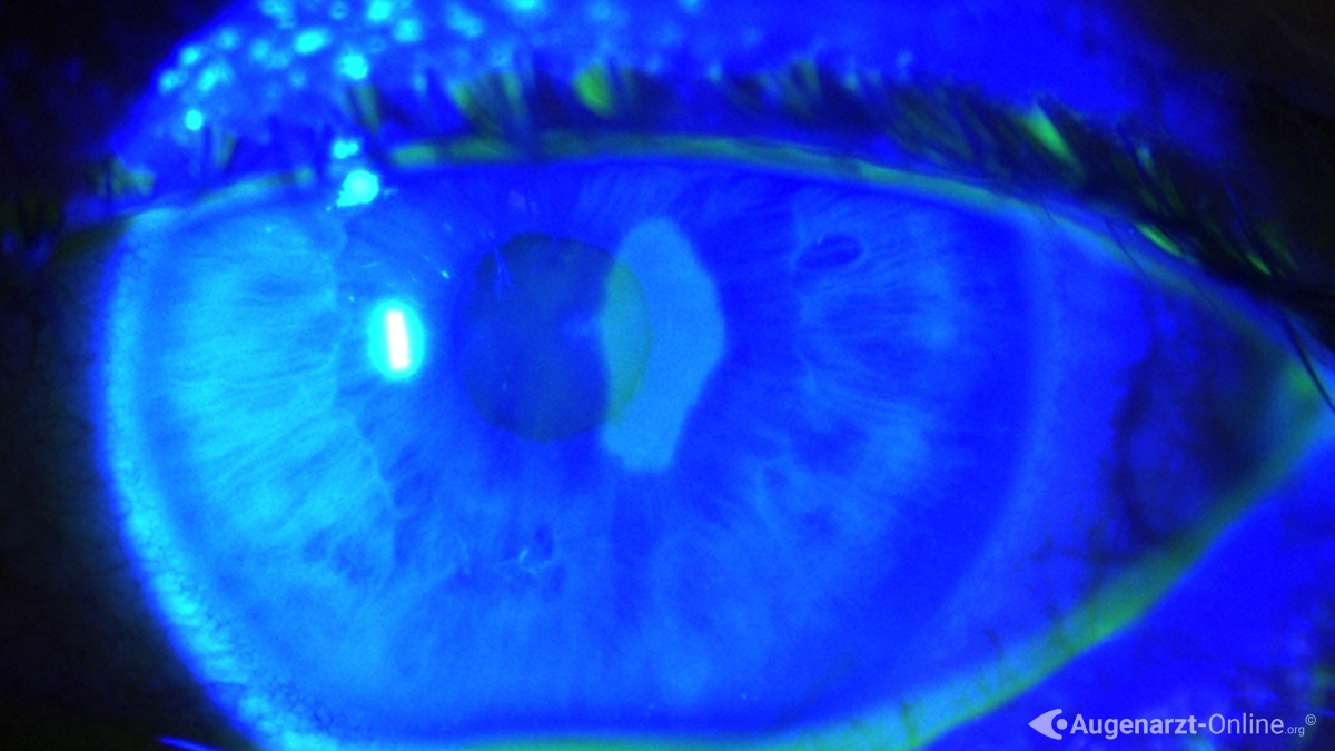Hornhautabschürfung nach Anfärbung im Kobalt Blaufilter