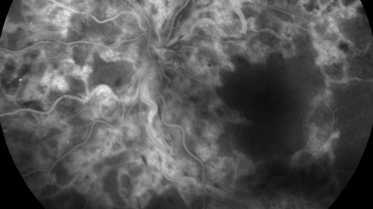 Angiographie bei Zentralvenenverschluss