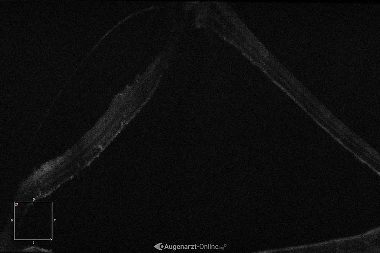 Netzhautablösung in Folge unbehandelter vitreomakuläre Traktion im Bereich der Makula.