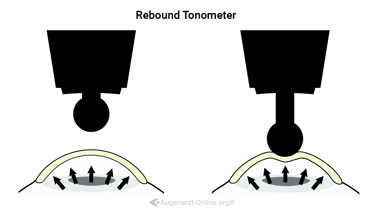 Funktionsweise und Erklärung der Funktionsweise der Rebound Tonometrie