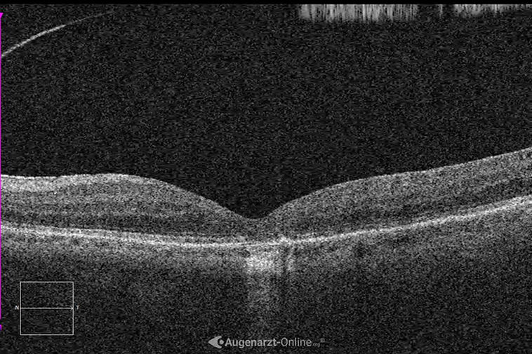 Netzhautatrophie im OCT.