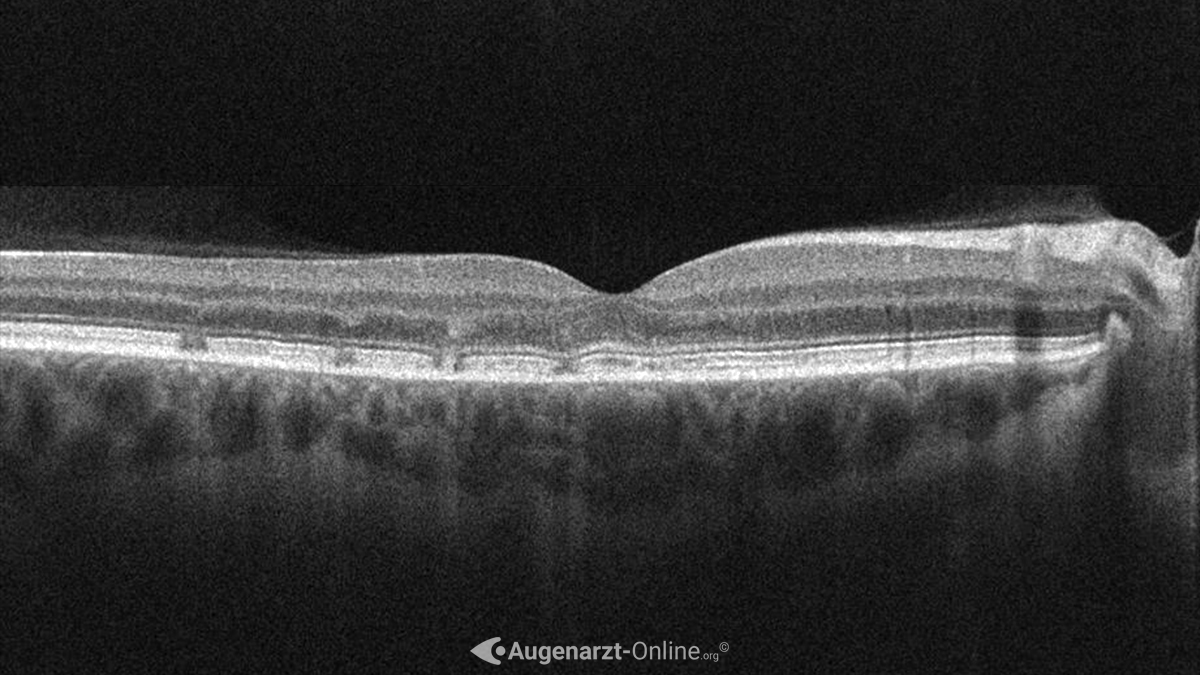 Tamoxifen induzierte Retinopathie