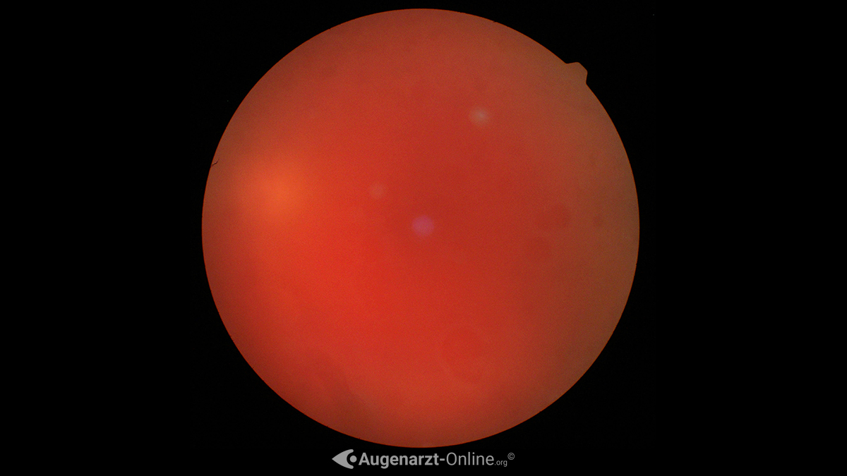 Spaltlampenfoto der intravitrealen Trübung einer Glaskörpertrübung