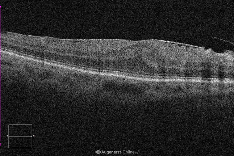 OCT mit Netzhautfalten bei epiretinaler Gliose.
