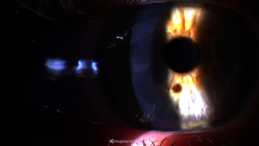 Zarte unscharf begrenzte Epitheltrübung einige Stunden nach Kontakt mit Superkleber.