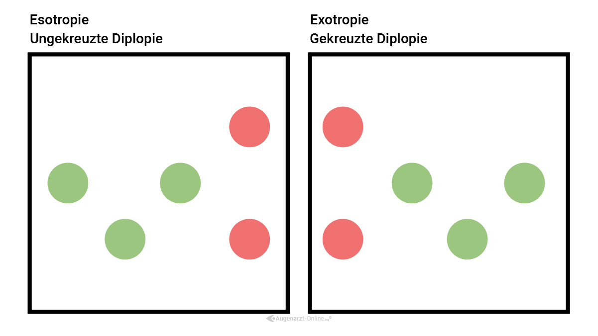 Esotropie und Exotropie im WFDT bei horizontaler Deviation