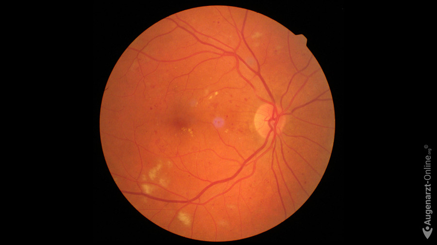 Cotton Wool Herd Lexikon der Augenheilkunde