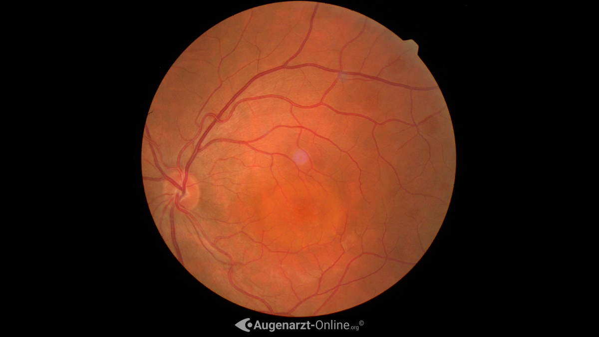 Fundusfoto einer Chorioretinopathia Centralis Serosa (CRCS)
