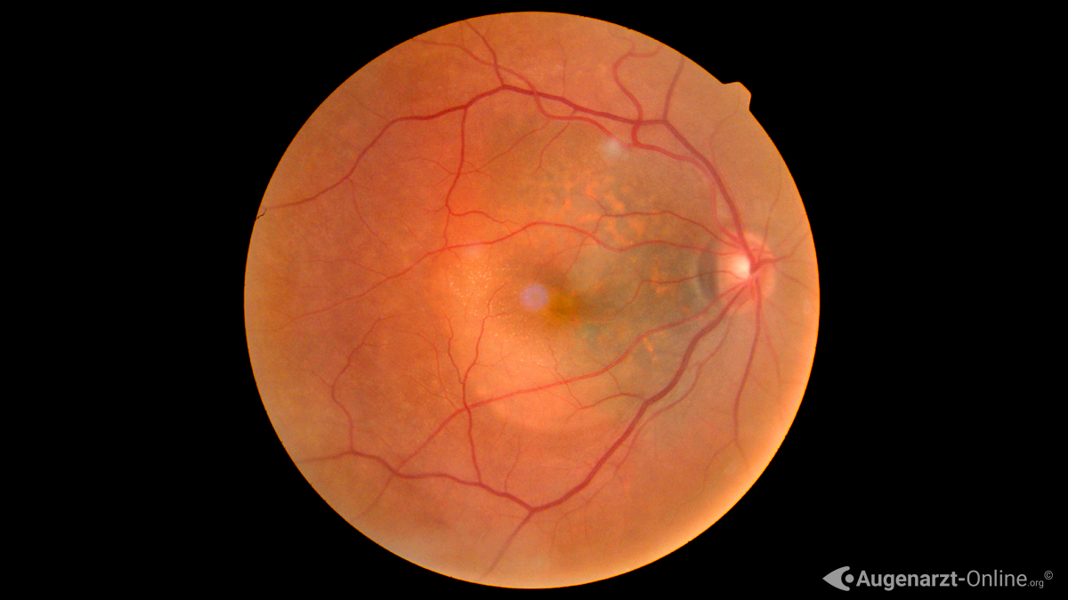 Aderhautmelanom, Augenkrebs, Augen Tumor, Uveales Melanom,