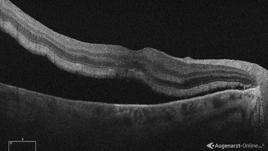 Optische Kohärenztomographie (OCT) einer Netzhautablösung. Es zeigt sich eine Abhebung der neurosensorischen Schicht mit Unterspülung der Fovea (Makula Off) .