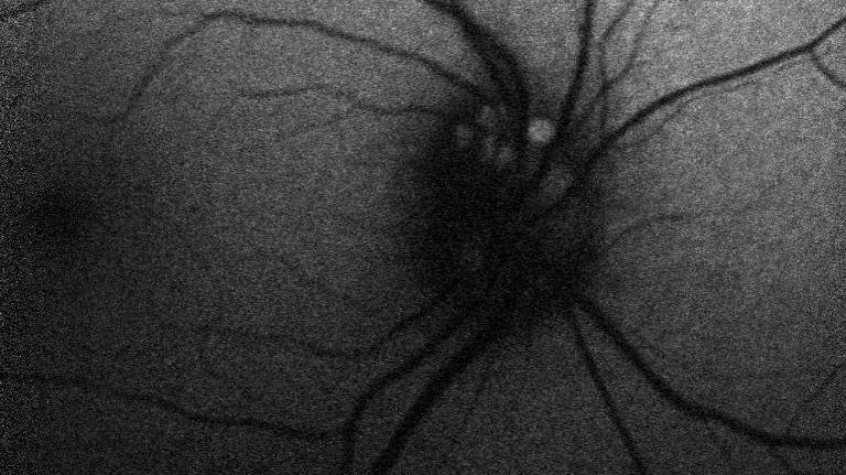 Als Drusenpapille bezeichnet man Ablagerungen im Sehnerven. In fortgeschrittenen Stadien kann es zu Gesichtsfeldeinschränkungen kommen. Durch eine Fundusautofluoreszenz kann die Verdachtsdiagnose  Drusenpapille gesichert werden.