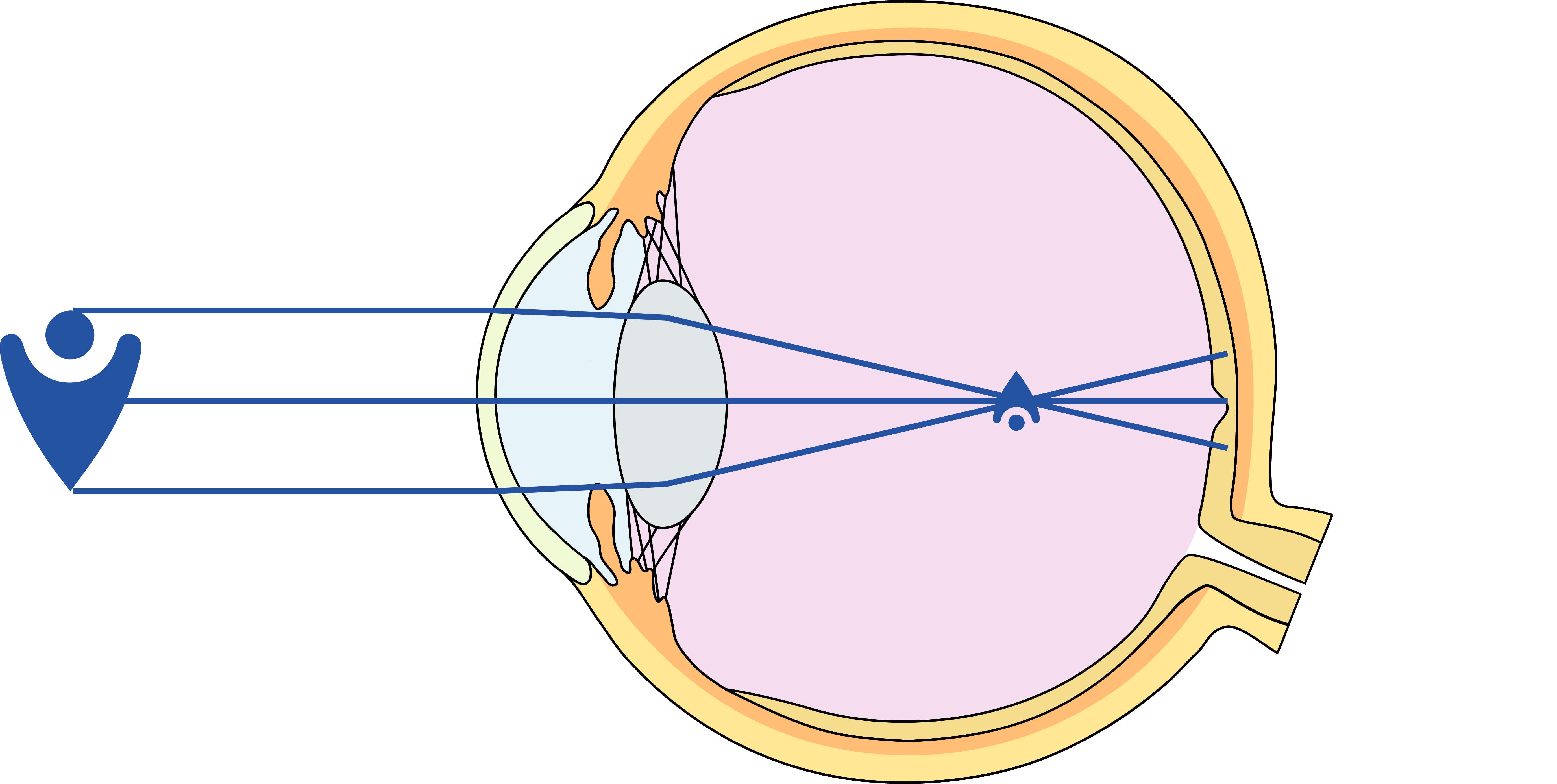 Kurzsichtigkeit Myopie Augenarzt Online Augen Wien