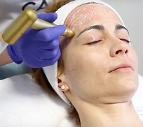 Micropuncion | Dermatologa Dra. Nadia Janette Rodríguez Zendejas | Guadalajara