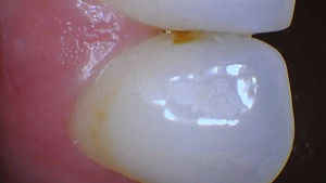 Composite Filling ✨