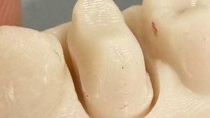 #5 zirconia crown prep