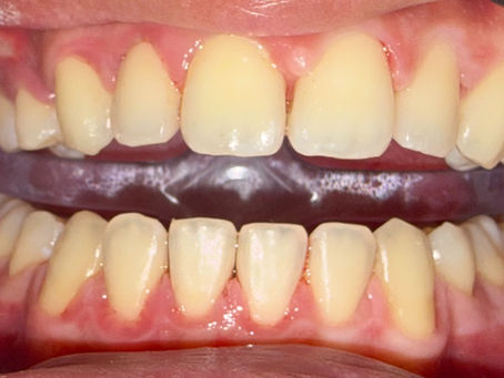 Gentle Stain Removal with EMS AIRFLOW Dental Cleaning